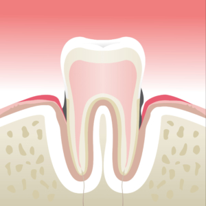 parodontologie velay